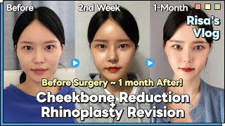 Plastic Surgery REVIEW Cheekbone Reduction  Rhinoplasty Revision in Korea [upl. by Ettezil257]