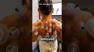 Cupping therapy huh 😨 [upl. by Geoffrey]