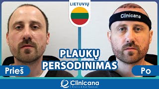 Plaukų Persodinimas Turkijoje  Plaukų Transplantacija Atsiliepimai  Klinikoje CLINICANA [upl. by Elehcin]