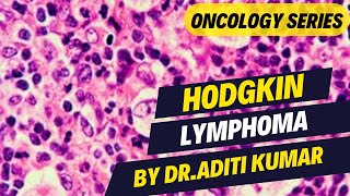 HODGKIN LYMPHOMA [upl. by Norym]