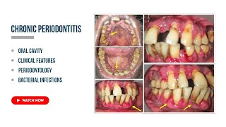 Chronic periodontitis Etiology Clinical features periodontal health [upl. by Larner]