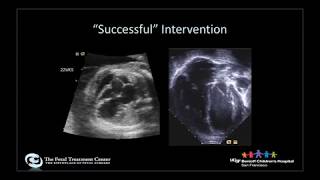 Fetal cardiac intervention Changing outcomes in congenital heart disease [upl. by Gusta854]