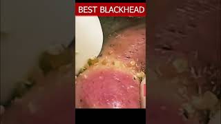 pimple popping 2022 new blackheads REMOVAL pimple popping tiktok 555 [upl. by Harvey14]