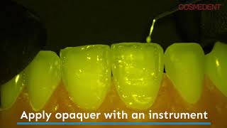 Enhancing the Halo Effect on Composite Restorations with Creative Color Opaquers [upl. by Lacram]