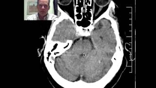 DISCUSSION of CT Head in 76yo patient with an acute MCA stroke [upl. by Yrekaz]