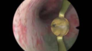 Rollerball Endometrial Ablation  Virtual Reality Simulation for Endoscopic Surgery [upl. by Philan]