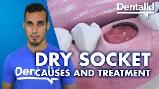 DRY SOCKET – Symptoms treatment and causes of INFECTED tooth extraction  Dentalk © [upl. by Adnalay928]