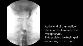 Swallowing disorders  Lateral pharyngeal ears [upl. by Nithsa]