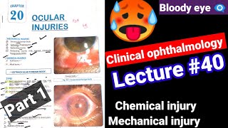 🔴Clinical ophthalmology lectures 40 ocular injuriesmechanicalchemical injury Contusion Hypema [upl. by Mortensen656]