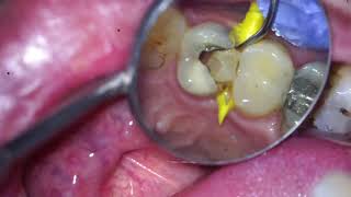 Class two restoration selective caries removal [upl. by Risa]