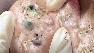 Big Cystic Acne Blackheads Extraction Blackheads amp Milia Whiteheads Removal Pimple Popping  3608 [upl. by Sakram]