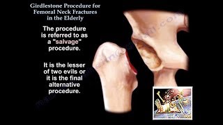 Girdlestone Procedure Hip Fractures Elderly  Everything You Need To Know  Dr Nabil Ebraheim [upl. by Assenay]