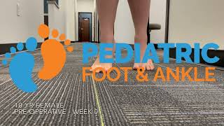 Childs Lifelong Toe Walking Resolved in Months via Achilles Lengthening Surgery [upl. by Jerrine]