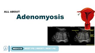 ADENOMYOSIS TYPES SYMPTOMS  DIAGNOSIS TREATMENT  NEETPG  INICET  MEDICOS [upl. by Carlita]