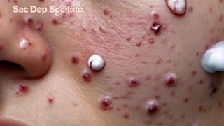 sac dep spa big deep blackheads  sac dep spa pimple popping Today new 2024 5 [upl. by Harp]