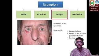 Ectropion Basics to Surgical aspects [upl. by Carmencita]