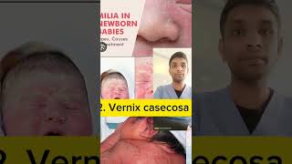 milia and vernix casecosa and lanugo shorts nursingeducation [upl. by Peterus219]