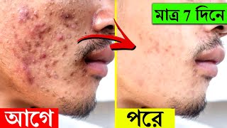 ব্রণ দূর করার সহজ উপায়  How To Remove Pimples Overnight  Acne Blackheads Treatment In Bengali [upl. by Yehtomit]