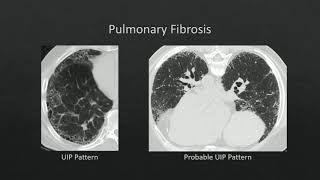 HRCT Pneumoconiosis [upl. by Llemhar244]