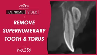 Extraction of supernumerary tooth  Lingual torus removal  Dr Cho Yongseok [upl. by Kipton]