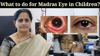 What to do for Madras Eye Infection in Childrenmadraseye eyeinfection viral [upl. by Alliber]