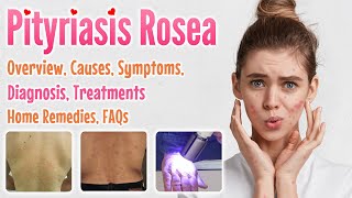 Pityriasis Rosea Overview Causes Signs and Symptoms Diagnosis Treatment Home Remedies and FAQs [upl. by Naesad]