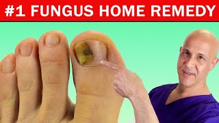 1 Best Home Remedy Cure for Toenail Fungus Dr Mandell [upl. by Wons]