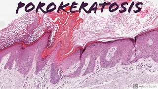 Porokeratosis 5Minute Pathology Pearls [upl. by Chilt]