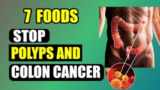 7 Superfoods to Get Rid of Colon Polyps and Prevent Bowel Cancer [upl. by Almap]