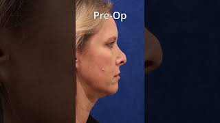 Revision Rhinoplasty Done Right [upl. by Harriott]