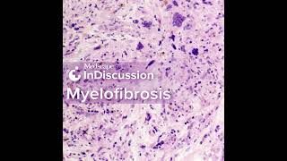 Whats Your Approach Treating Myelofibrosis [upl. by Dollar]