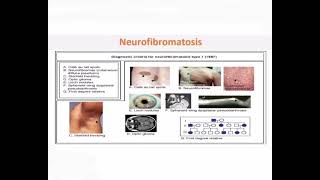 Neurofibromatosis mrcpch Clinical [upl. by Eintirb]