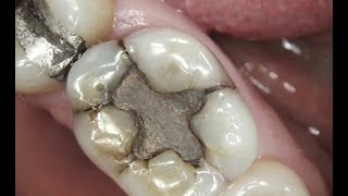 Amulgum filling procedure  Amulgum filling chandee ke filling in teeth 🦷 like subscribe plz [upl. by O'Gowan]