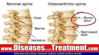 3 Osteophytes Bone Spur Causes Symptoms Diagnosis Treatment [upl. by Camey]