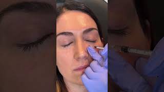 Under Eye Filler shorts undereyefiller [upl. by Atneciv]