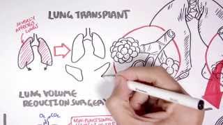 Emphysema Treatment [upl. by Nommad280]