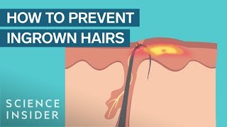 What Are Ingrown Hairs — And How To Treat Them [upl. by Charpentier17]