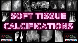 SOFT TISSUE CALCIFICATIONS [upl. by Idleman198]