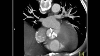 4D Imaging of the Aortic Valve Aortic valve 3 of 3 [upl. by Olen]