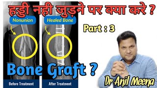 What is bone graft  Bone Graft in Non United Fracture  bone grafting Procedure  In Hindi [upl. by Anitreb]