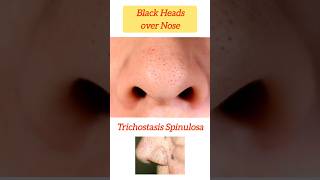 Black Heads amp Hairs over Nose  Trichostasis Spinulosa noseblackheads nosehair blackheads nose [upl. by Alyek]