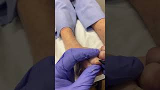 Dive into this satisfying callus removal journey with an Aussie podiatrist [upl. by Idell]