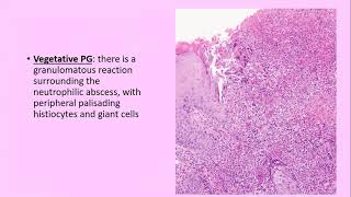 Lecture99 Neutrophilic Dermatoses Pyoderma Gangrenosum amp Sweets syndrome PartI Rooks Ch 49 [upl. by Renmus339]