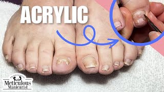 Big Toenail Repair Pedicure Tutorial at Home [upl. by Onifur]