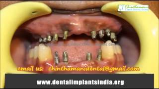 Teeth Restoration Chennai  Full Mouth Reconstruction India [upl. by Niamreg]