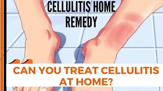 Can You Treat Cellulitis at Home  cellulitis home remedy [upl. by Eniwtna]