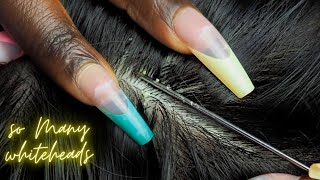 ASMR ATTENTIVE Scalp NITPICKING so many 😴 WHITEHEADS  super zoomed [upl. by Assilak]