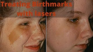 How to treat birthmarks [upl. by Eatnod]