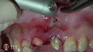 Restorative Crown Lengthening in Esthetic Zone amp Apicoectomy with Giuded Tissue Regeneration IV [upl. by Nywles]