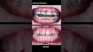 Fix openbite teeth with braces braces orthodontist dentist niengrang [upl. by Neerroc]